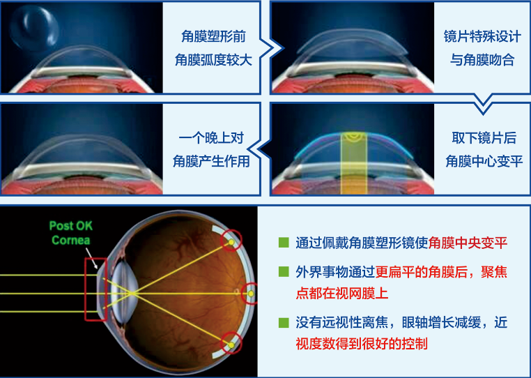 近视不想戴眼镜？试试这3种方法…